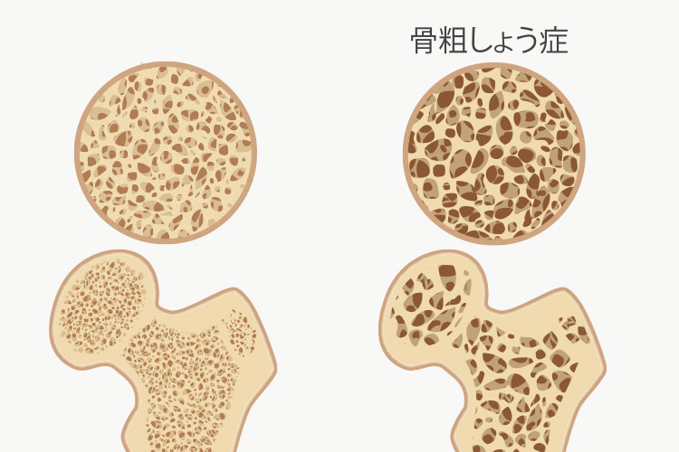 骨粗しょう症のイメージ写真